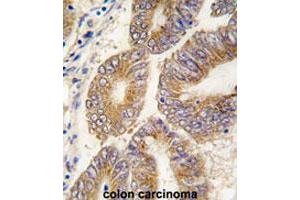 Formalin-fixed and paraffin-embedded human colon carcinomareacted with AHCY polyclonal antibody , which was peroxidase-conjugated to the secondary antibody, followed by AEC staining. (AHCY anticorps  (C-Term))