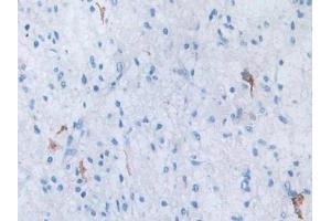 Detection of NCCT in Human Glioma Tissue using Polyclonal Antibody to Na-Cl Cotransporter (NCCT)