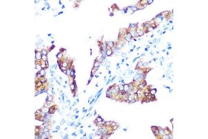 Immunohistochemistry of paraffin-embedded human oophoroma using IMP3 Rabbit mAb (ABIN7267904) at dilution of 1:100 (40x lens). (IGF2BP3 anticorps)