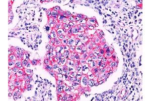 Formalin-fixed, paraffin-embedded breast ductal carcinoma stained with Catenin, beta PAb.