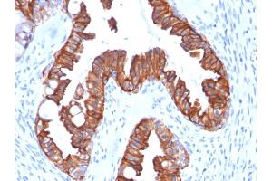 Formalin-fixed, paraffin-embedded human Endometrial Carcinoma stained with CK7 Recombinant Mouse Monoclonal Antibody (rOV-TL12/30). (Recombinant Cytokeratin 7 anticorps)