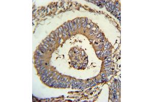 CALR Antibody (ABIN652259 and ABIN2841097) immunohistochemistry analysis in formalin fixed and paraffin embedded human colon carcinoma followed by peroxidase conjugation of the secondary antibody and DAB staining. (Calreticulin anticorps)