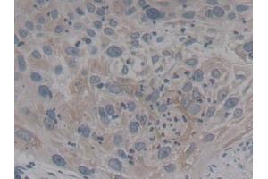 Detection of NTRK3 in Human Lung cancer Tissue using Polyclonal Antibody to Neurotrophic Tyrosine Kinase Receptor Type 3 (NTRK3)