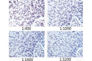 Immunohistochemistry of paraffin-embedded human esophageal cancer using Lamin A/C antibody (ABIN7268177) at dilution of 1:400 - 1:3200 (40x lens). (Lamin A/C anticorps)