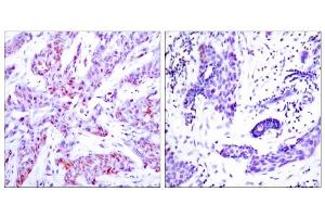 Immunohistochemical analysis of human paraffin-embedded human breast carcinoma tissue using ATF4 (Ab-245) antibody (E021053). (ATF4 anticorps)