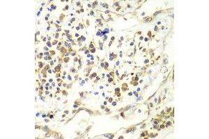 Immunohistochemistry of paraffin-embedded human liver cancer using UPF1 antibody at dilution of 1:100 (x40 lens). (RENT1/UPF1 anticorps)