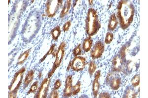 Formalin-fixed, paraffin-embedded human Gastric Carcinoma stained with MUC6 Monoclonal Antibody (MUC6/916). (MUC6 anticorps)
