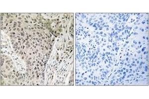 Immunohistochemistry analysis of paraffin-embedded human lung carcinoma, using ARHGEF19 Antibody. (ARHGEF19 anticorps  (AA 251-300))