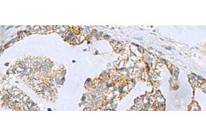 Immunohistochemistry of paraffin-embedded Human gastric cancer tissue using MGME1 Polyclonal Antibody at dilution of 1:70(x200) (C20orf72 anticorps)