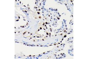 Immunohistochemistry of paraffin-embedded human thyroid cancer using [KO Validated] Cyclin D1 Rabbit mAb (ABIN7266561) at dilution of 1:100 (40x lens).