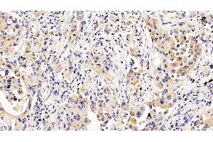 Detection of IL5Ra in Human Lung cancer Tissue using Polyclonal Antibody to Interleukin 5 Receptor Alpha (IL5Ra) (IL5RA anticorps  (AA 42-182))