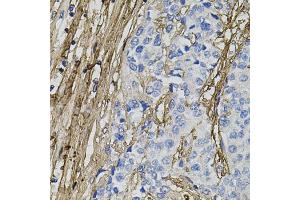 Immunohistochemistry of paraffin-embedded human prostate cancer using COL1A1 antibody. (COL1A1 anticorps)