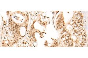 Immunohistochemistry of paraffin-embedded Human colorectal cancer tissue using ARID1B Polyclonal Antibody at dilution of 1:40(x200) (ARID1B anticorps)