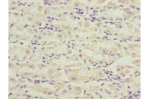 Immunohistochemistry of paraffin-embedded human gastric cancer using ABIN7162519 at dilution of 1:100