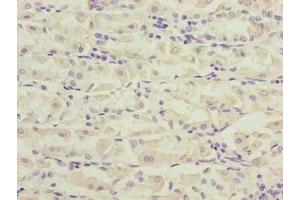 Immunohistochemistry of paraffin-embedded human gastric cancer using ABIN7162519 at dilution of 1:100 (PILRB anticorps  (AA 20-191))