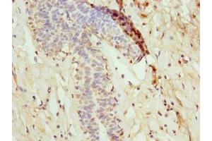 Immunohistochemistry of paraffin-embedded human breast cancer using ABIN7160728 at dilution of 1:100 (NANP anticorps  (AA 1-248))