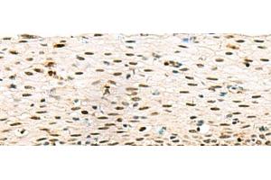 Immunohistochemistry of paraffin-embedded Human cervical cancer tissue using ABI2 Polyclonal Antibody at dilution of 1:45(x200) (ABI2 anticorps)