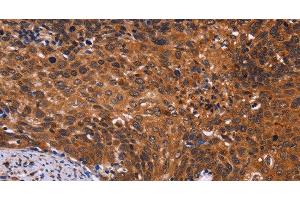 Immunohistochemistry of paraffin-embedded Human cervical cancer tissue using CDC5L Polyclonal Antibody at dilution 1:40