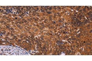 Immunohistochemistry of paraffin-embedded Human cervical cancer tissue using CDC5L Polyclonal Antibody at dilution 1:40 (CDC5L anticorps)