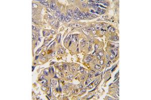 Formalin-fixed and paraffin-embedded human colon carcinoma tissue reacted with Autophagy G16L antibody , which was peroxidase-conjugated to the secondary antibody, followed by DAB staining. (ATG16L1 anticorps  (AA 161-190))