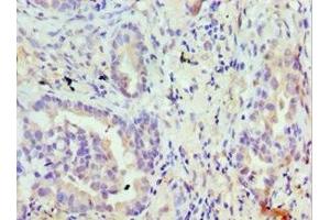 Immunohistochemistry of paraffin-embedded human lung cancer using ABIN7172874 at dilution of 1:100 (TRPM8 anticorps  (AA 980-1104))