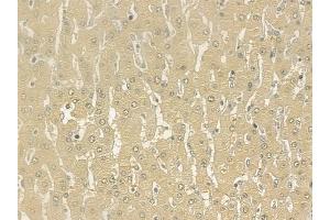 ABIN6261313 and ABIN6277179 at 1/100 staining human hepatocellular carcinoma by IHC-P.