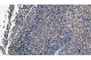 Detection of PECAM1 in Human Endometrial cancer Tissue using Polyclonal Antibody to Platelet/Endothelial Cell Adhesion Molecule (PECAM1)