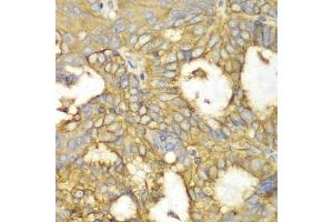 Immunohistochemistry of paraffin-embedded human oophoroma using PRKAR1A antibody.