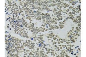 Immunohistochemistry of paraffin-embedded human lung cancer using PPP4C antibody. (PPP4C anticorps  (AA 1-307))