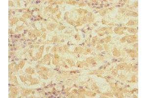 Immunohistochemistry of paraffin-embedded human gastric cancer using ABIN7149799 at dilution of 1:100