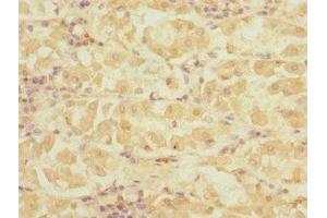 Immunohistochemistry of paraffin-embedded human gastric cancer using ABIN7149799 at dilution of 1:100 (DET1 anticorps  (AA 15-240))
