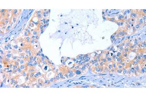 Immunohistochemistry of paraffin-embedded Human cervical cancer tissue using ARRB1 Polyclonal Antibody at dilution 1:50 (beta Arrestin 1 anticorps)
