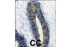 Formalin-fixed and paraffin-embedded human colon carcinoma reacted with FUBI Antibody , which was peroxidase-conjugated to the secondary antibody, followed by DAB staining.