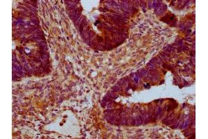 IHC image of ABIN7167248 diluted at 1:400 and staining in paraffin-embedded human ovarian cancer performed on a Leica BondTM system.