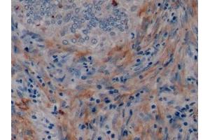 Detection of MUC1 in Human Endometrial cancer Tissue using Polyclonal Antibody to Mucin 1 (MUC1)