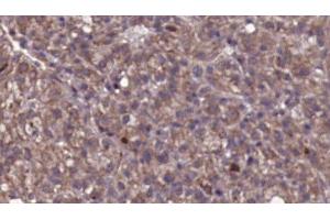 ABIN6276801 at 1/100 staining Human liver cancer tissue by IHC-P.
