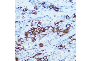 Immunohistochemistry of paraffin-embedded human esophageal cancer using Cytokeratin 5 (KRT5) (KRT5) Rabbit mAb (ABIN7268103) at dilution of 1:100 (40x lens). (Cytokeratin 5 anticorps)