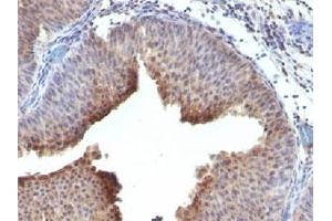 IHC testing of FFPE human bladder carcinoma and Cytokeratin 6 antibody. (Keratin 6 anticorps  (C-Term))
