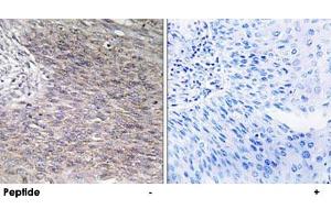 Immunohistochemistry analysis of paraffin-embedded human cervix carcinoma tissue using CHPF polyclonal antibody . (CHPF anticorps)