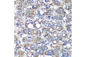 Immunohistochemistry of paraffin-embedded Human liver cancer using TIMMDC1 Rabbit pAb (ABIN7270929) at dilution of 1:100 (40x lens). (TIMMDC1 anticorps  (AA 206-285))