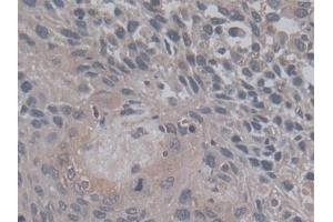 IHC-P analysis of Human Lung cancer Tissue, with DAB staining. (TGFB3 anticorps  (AA 24-300))