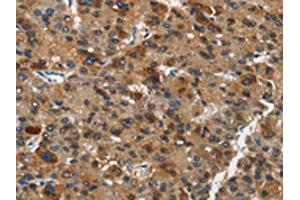 The image on the left is immunohistochemistry of paraffin-embedded Human liver cancer tissue using ABIN7190434(DCC Antibody) at dilution 1/70, on the right is treated with synthetic peptide. (DCC anticorps)