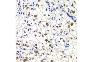 Immunohistochemistry of paraffin-embedded human kidney cancer using GTF2F2 antibody (ABIN6131726, ABIN6141494, ABIN6141496 and ABIN6217519) at dilution of 1:200 (40x lens).