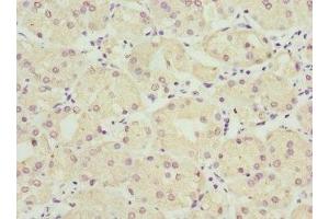 Immunohistochemistry of paraffin-embedded human gastric cancer using ABIN7149954 at dilution of 1:100 (FMO1 anticorps  (AA 363-532))