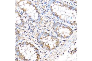 Immunohistochemistry of paraffin-embedded Human colon using MMP17 Rabbit pAb (ABIN3017219, ABIN3017220, ABIN3017221 and ABIN1680859) at dilution of 1:100 (40x lens).
