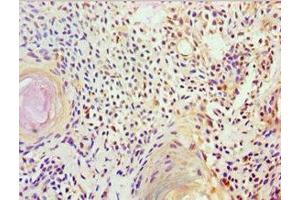 Immunohistochemistry of paraffin-embedded human breast cancer using ABIN7152570 at dilution of 1:100 (FUBP3 anticorps  (AA 65-260))