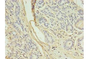 Immunohistochemistry of paraffin-embedded human breast cancer using ABIN7145079 at dilution of 1:100 (Aurora Kinase B anticorps  (AA 1-255))