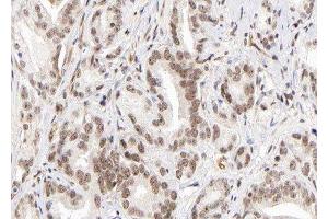 ABIN6279558 at 1/100 staining human Prostate carcinoma tissue sections by IHC-P. (Lysine (K)-Specific Methyltransferase 2B (KMT2B) (Internal Region) anticorps)