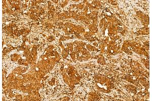 ABIN6260760 and ABIN6272939 at 1/100 staining Human breast cancer by IHC-P.