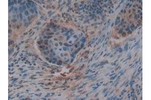 Detection of THBS1 in Human Esophagus cancer Tissue using Polyclonal Antibody to Thrombospondin 1 (THBS1)